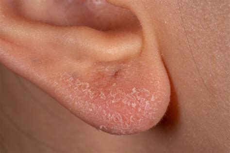 What Causes Dry Ears Open Web Portal