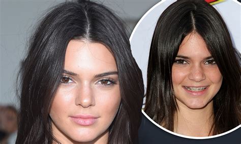 Kendall Jenner Reveals Her Acne Was So Bad She Couldnt Make Eye Contact
