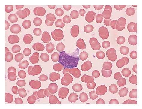 Peripheral Blood Smear A Mature Eosinophil With Hypogranulation And