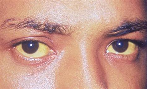 Medical Pictures Info Yellow Sclera