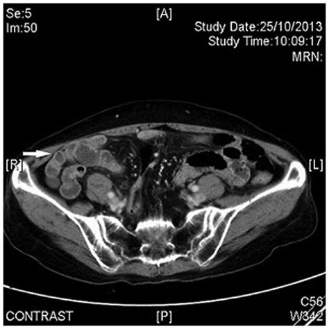 Severe Ileitis Associated With Capecitabine Two Case Reports And