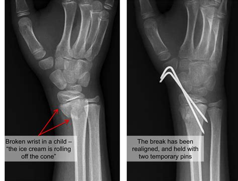 I Broke My Wrist Now What — Joseph J Schreiber Md