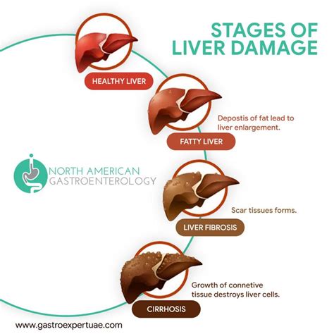 Stages Of Liver Damage Liver Health Healthy Liver Medical Anatomy