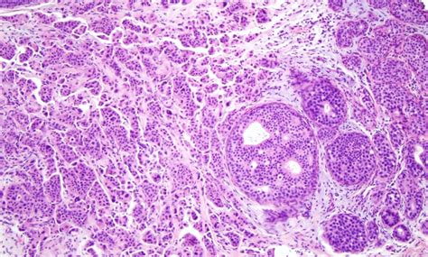 Figure Invasive Ductal Carcinoma Image Of StatPearls NCBI