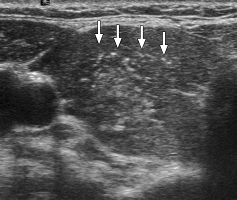 Papillary Thyroid Carcinoma Manifested Solely As Microcalcifications On