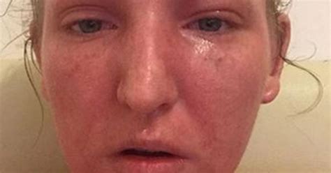 Eczema Sufferer S Hell As Addiction To Prescribed Steroid Cream Leaves Her Bedridden And