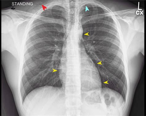 Cureus Pneumothorax After A Fall In A Healthy Adolescent Athlete