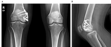 A Novel Technique For Fixation Of A Medial Femoral Condyle Fracture