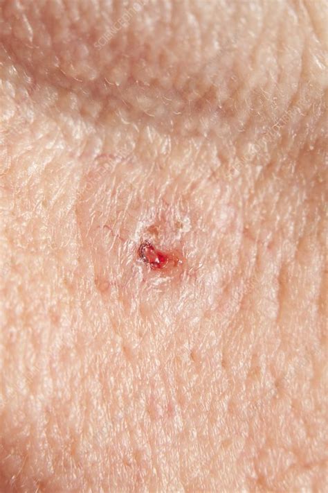 Basal Cell Carcinoma Stock Image C0150916 Science Photo Library