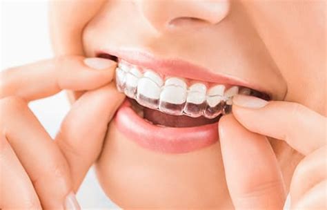 Orthodontic Braces Edmonton Dental Braces In Edmonton
