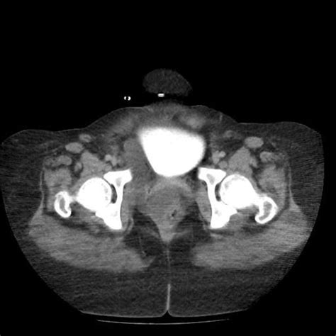Abdominal Retroperitoneal Cystic Lymphangioma Radiology Case