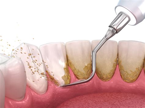 How Dental Scaling And Root Planing Help Prevent Gum Disease