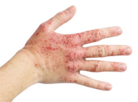 Fda Approves Dupixent To Treat Moderate To Severe Eczema
