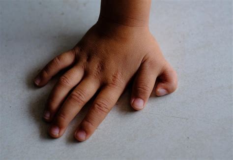 Babies Born With Extra Fingers And Toes Causes Treatment