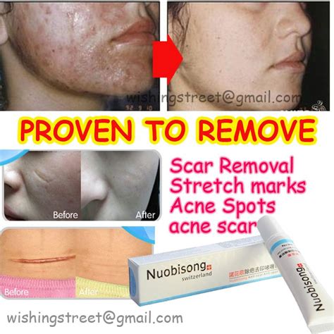 Nuobisong Face Care Acne Scar Removal Cream Acne Spots Skin Care Treatment Whitening Face Cream