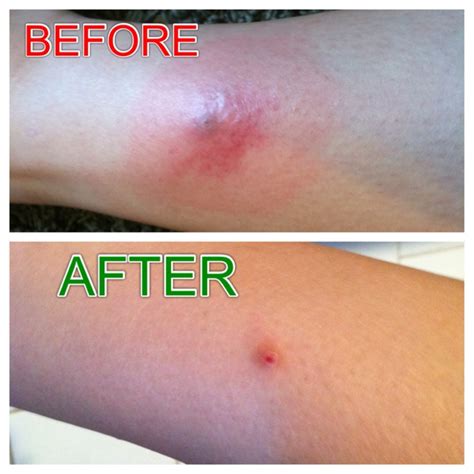 224 Best Images About Mrsa On Pinterest Health Tea Tree Oil And Cure