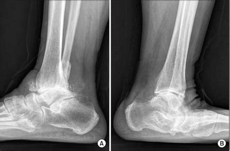 A Lateral Radiograph Showing The Severe Rheumatoid Arthritis Of The