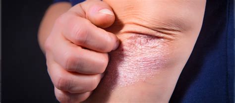 8 Ways To Relieve Itchy Psoriasis Eczema Awareness Monthly An