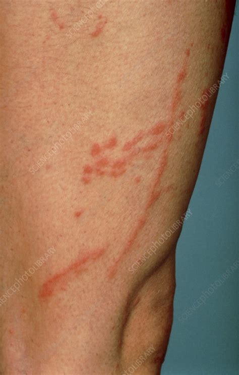 Contact Dermatitis Due To Poison Oak Showing Rash Stock Image M140