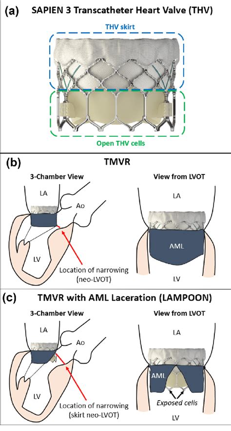 Transcatheter Mitral Valve Replacement And The Lampoon Procedure