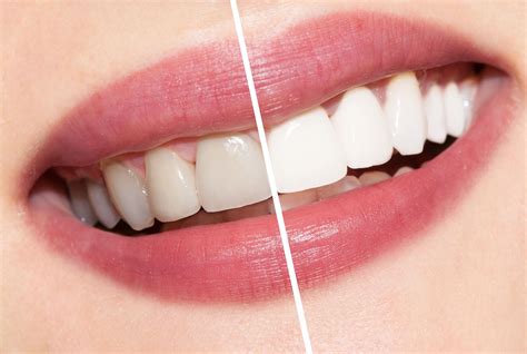 Teeth Whitening Secrets