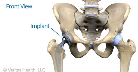 All About Anterior Hip Replacement Hip Replacement Surgery Total Hip