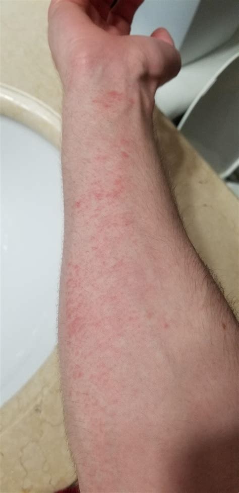 Rash Forming On Right Arm Should I Be Concerned R Accutane