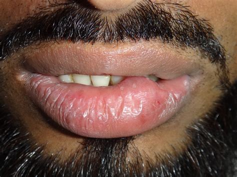 What Causes Cysts On Lips