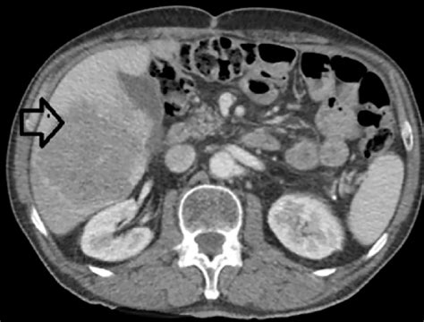 Cureus Resection Of Large Metachronous Liver Metastasis With Gastric Origin Case Report And