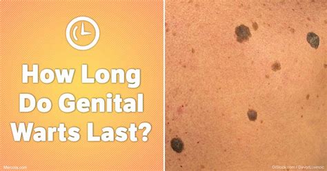 How Long Do Genital Warts Last