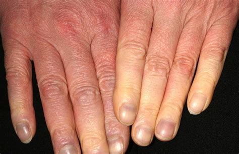 Early Signs Of Raynauds Disease Recognize Disease