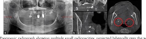 Figure 3 From Considerations In Detecting Soft Tissue Calcifications On