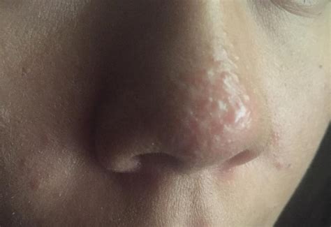 Nose Scars Acne Or Rosacea General Acne Discussion