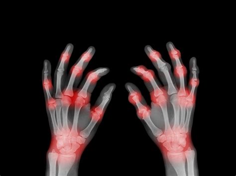 Osteoarthritis And Wear And Tear Of Joint Cartilage