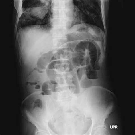 Abdominal X Ray Shows Air Fluid Levels In The Dilated Small Intestine