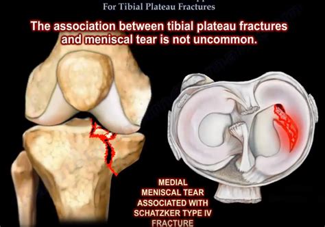 Extensile Approach For Tibial Plateau Fractures —