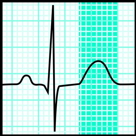 The de winter electrocardiogram (ekg) pattern is a novel sign that indicates left anterior descending coronary artery (lad) occlusion in. T wave - Wikipedia