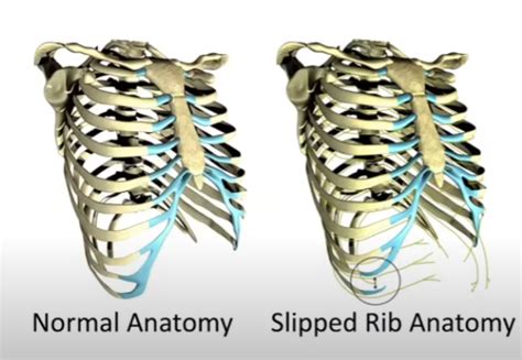 Slipping Rib Syndrome Wikimsk