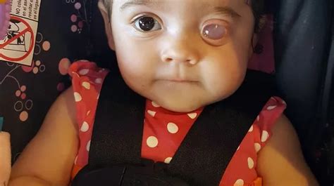 Adorable Baby Born With One Eye To Undergo A Gruelling Procedure To