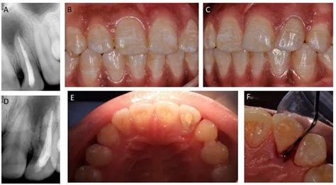 We did not find results for: A) Pre-operative Radiograph with a periapical radiolucency ...