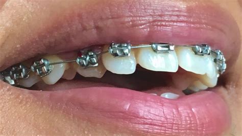 Braces Time Lapse Impacted Canine Before And After Youtube