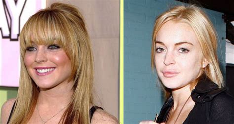 Lindsay Lohan Before And After Lip Injections Young Kennel