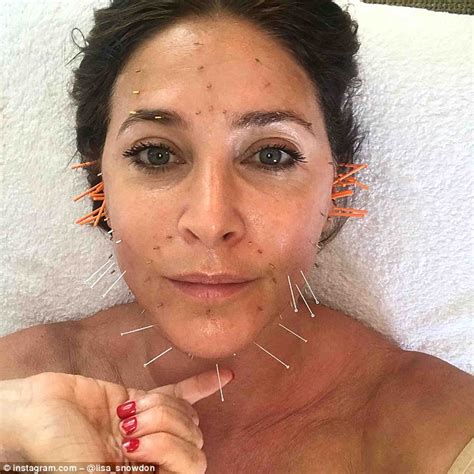 Lisa Snowdon Turns To Acupuncture After Boozy Holiday Daily Mail Online