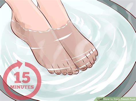 How To Treat Trench Foot 11 Steps With Pictures Wikihow