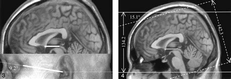 Clinical Brain Mr Imaging Prescriptions In Talairach Space