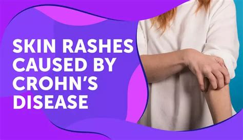 Rashes Are A Common Occurrence For People With Crohns Disease