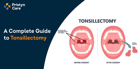 A Complete Guide To Tonsillectomy Pristyn Care