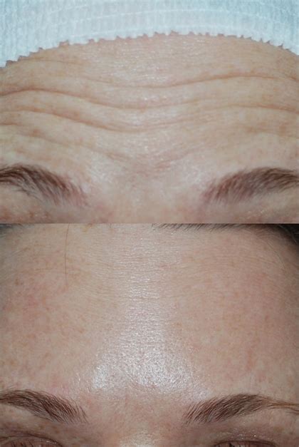 Fine Line And Wrinkles Laser Treatments Pinehurst Nc