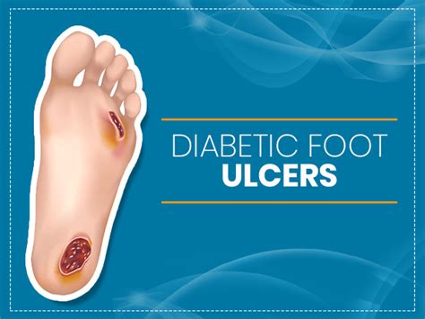 Diabetic Foot Ulcers Causes Types Symptoms Diagnosis Treatment