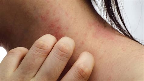 Worried About Your Childs Rash When To Call A Doctor Angi